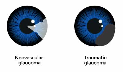 Two diagrams of eyes illustrating neovascular and traumatic glaucoma.