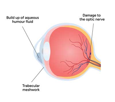 Diagram of an eye showing fluid buildup and optic nerve damage.