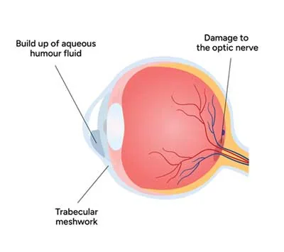 Diagram of an eye showing fluid buildup and optic nerve damage.